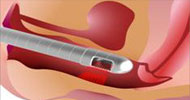 Botox in Urologie