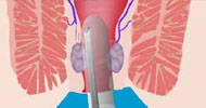 HeLP™ Hemorrhoid Laser Procedure